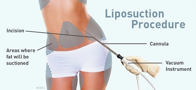 Best Liposuction Treatment Gurgaon